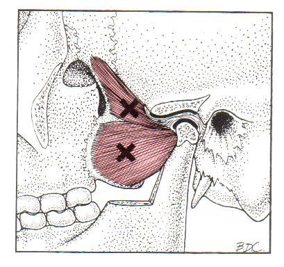 Lateral Pterygoid Travell and Simons